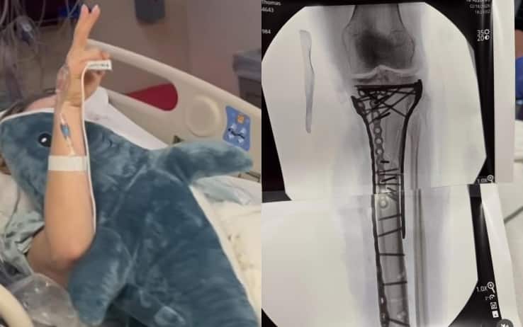 Lindsey Vonn, 5^ operazione dopo caduta alle Olimpiadi: radiografia sui social 
