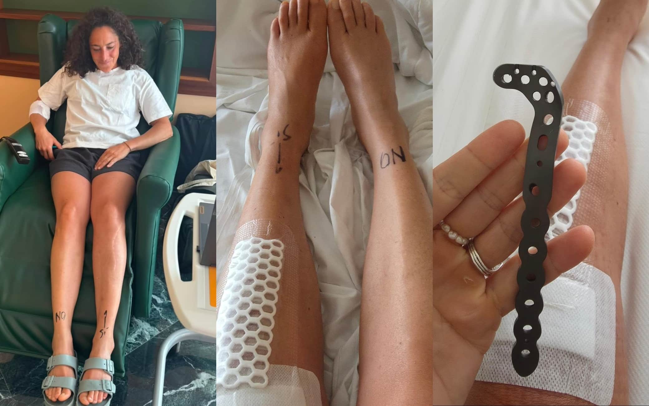 Brignone, post social dopo l'operazione: "Ferraglia tolta e ginocchio pulito: sto bene!"