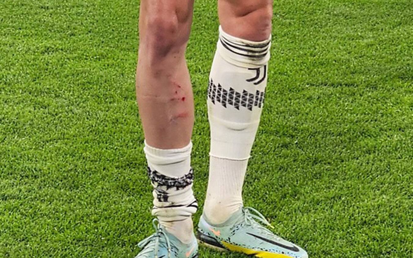 I segni evidenti del fallo sul polpaccio di Rabiot